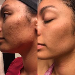 Before and After 6 months (left)