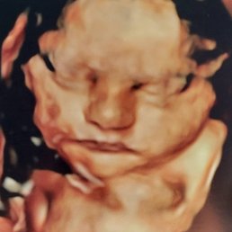 Baby girl at about 31 weeks
