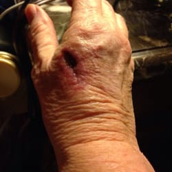 Grafton Dermatology & Cosmetic Surgery - Scar