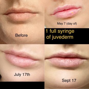 Radiance Medspa San Antonio - 1 full syringe of juvederm- cost $700 - Medical Spas Near Me - San Antonio, Texas