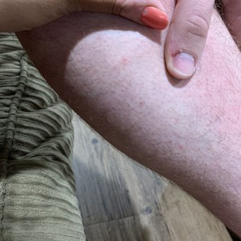 Double JJ Resort - Bed bug bite - Resorts Near Me - Rothbury, Michigan Double JJ Resort - Bed bug bite - Resorts Near Me - Rothbury, Michigan
