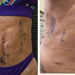 Texas Liposuction Specialty Clinic - Had lipo revision ans skin tightening  on Sept 5. Very happy so far with my results.