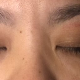The area she burned me during an eye brow wax. (48 hours after the waxing) The area she burned me during an eye brow wax. (48 hours after the waxing)