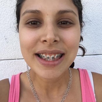 Star Bright Orthodontics - Brackets only. Before any wire or movement. - Orthodontists Near Me - West Covina, California Star Bright Orthodontics - Brackets only. Before any wire or movement. - Orthodontists Near Me - West Covina, California