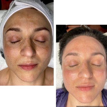 Esthetic Laser Clinic - Lira Clinical Green Power. Treatment helps to increase healthy cell turnover, tighten, brightens and lightens the skin. - Laser Hair Removal Near Me - Vienna, Virginia Esthetic Laser Clinic - Lira Clinical Green Power. Treatment helps to increase healthy cell turnover, tighten, brightens and lightens the skin. - Laser Hair Removal Near Me - Vienna, Virginia