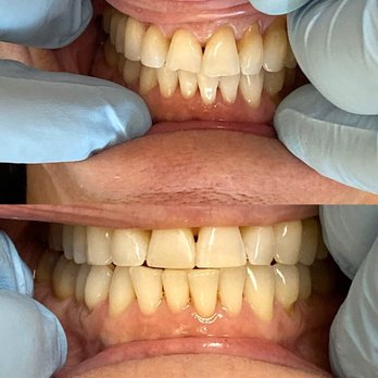 James E. Fitzgerald, DDS - Before and after on tooth contouring and filling.  Amazing and super cheap compared to laminates. - Cosmetic Dentists Near Me - Brisbane, California