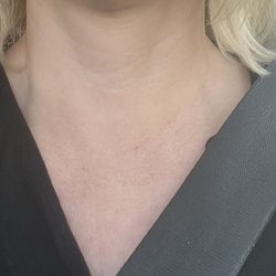 Bhuiya Aref MD - After CO2
