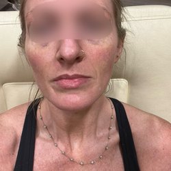 Raval Facial Aesthetics and Rocky Mountain Laser Aesthetics - Before any Botox or lip filler