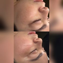 BioRePeel treatment for Melasma