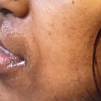 Simply Injectables  - Side view  before injections - Medical Spas Near Me - Providence, Rhode Island