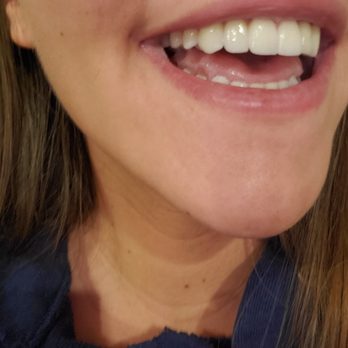 Pamela Marzban - Dr. Sirlanli's work - Cosmetic Dentists Near Me - Burke, Virginia Pamela Marzban - Dr. Sirlanli's work - Cosmetic Dentists Near Me - Burke, Virginia