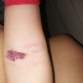 Clinical Pathology Laboratories - Forest Creek - My 2 yr olds arm after the blew a vein digging around in his arm. - Laboratory Testing Near Me - Round Rock, Texas Clinical Pathology Laboratories - Forest Creek - My 2 yr olds arm after the blew a vein digging around in his arm. - Laboratory Testing Near Me - Round Rock, Texas