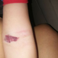 Clinical Pathology Laboratories - Forest Creek - My 2 yr olds arm after the blew a vein digging around in his arm.
