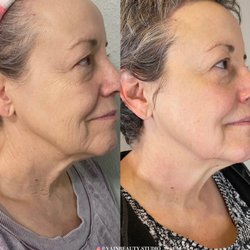 Vain Beauty Aesthetics - 2 sessions of RF Facial