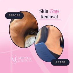 M Med Spa and Beauty - Skin tag removal.