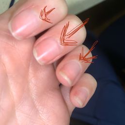 Drilled through nail at the cuticle line. Drilled through nail at the cuticle line.