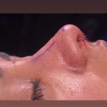 Aaron Kosins, MD - After - Cosmetic Surgeons Near Me - Newport Beach, California