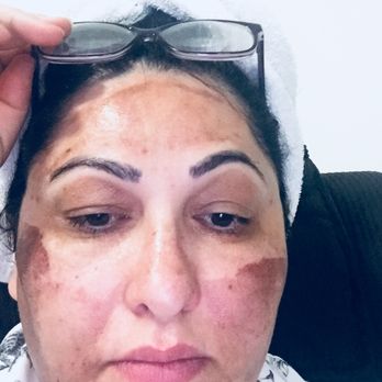 Carl Clarke Aesthetiques - I've posted my review, my name is Lale this is my face after two weeks of the chemical peel. - Medical Spas Near Me - Astoria, New York Carl Clarke Aesthetiques - I've posted my review, my name is Lale this is my face after two weeks of the chemical peel. - Medical Spas Near Me - Astoria, New York