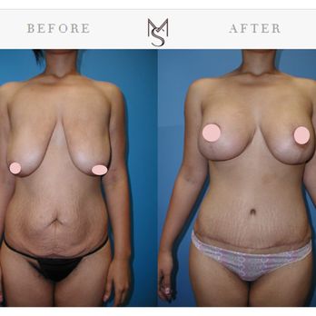 Mossi Salibian, MD - Mommy Makeover - Cosmetic Surgeons Near Me - West Hollywood, California Mossi Salibian, MD - Mommy Makeover - Cosmetic Surgeons Near Me - West Hollywood, California