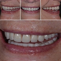 Alison Fishman, DMD - Peninsula Prosthodontic Group - Dentures: Esthetic and Functional. Utilizing dental implants.