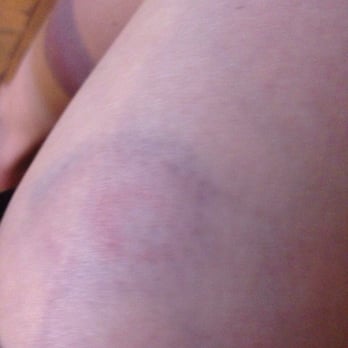 Splatterpark Paintball Games - Got hit in the leg - Paintball Near Me - Mount Gilead, Ohio Splatterpark Paintball Games - Got hit in the leg - Paintball Near Me - Mount Gilead, Ohio
