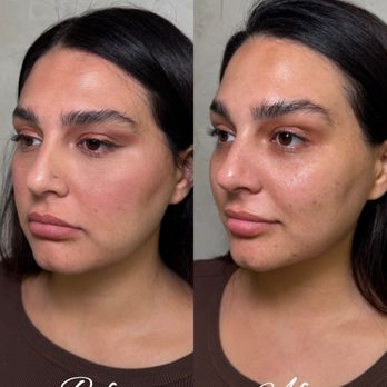 The Shene Skin - Before and after pictures of Buccal Massage - Skin Care Near Me - Irvine, California The Shene Skin - Before and after pictures of Buccal Massage - Skin Care Near Me - Irvine, California