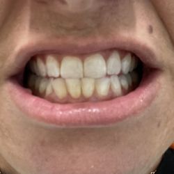 De Zavala Dental - Before cleaning & whitening