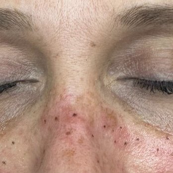 Urban shade Artistry - Freckles - Permanent Makeup Near Me - Indianapolis, Indiana Urban shade Artistry - Freckles - Permanent Makeup Near Me - Indianapolis, Indiana