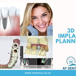 KF Dental - 3D Implant Planning