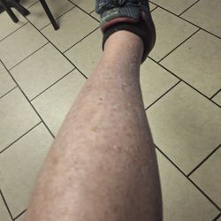 The Center For Bone And Joint Disease - My leg 6 months later.