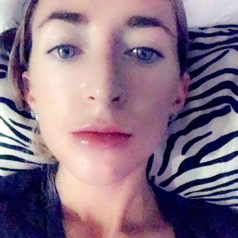 Steven J Varkony, MD - Do not get your lips done by Dr. Varkony! THIS is how lips should look after 1ml of juvederm, done by a professional, cyst-free - Cosmetic Surgeons Near Me - Encino, California Steven J Varkony, MD - Do not get your lips done by Dr. Varkony! THIS is how lips should look after 1ml of juvederm, done by a professional, cyst-free - Cosmetic Surgeons Near Me - Encino, California