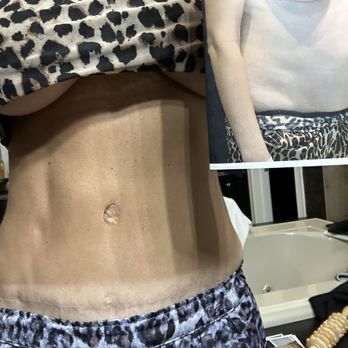 Smith Plastic Surgery - before and after  - as you can see my scare is very low and bikini bottom covers it - Cosmetic Surgeons Near Me - Las Vegas, Nevada