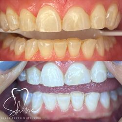 Shine Laser Teeth Whitening Spa