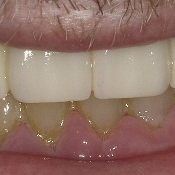 Kuzma DDS: Cosmetic & Implant Dentistry - Upper arch - General Dentistry Near Me - Fairfield, California Kuzma DDS: Cosmetic & Implant Dentistry - Upper arch - General Dentistry Near Me - Fairfield, California