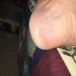 How my heel looked after my  18 minute pedicure. It feels rougher now than it did before