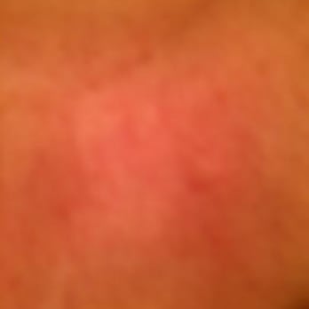 Motel 6 - Bed Bug Bite moments from when I was awoken from my sleep! - Hotels Near Me - Winslow, Arizona