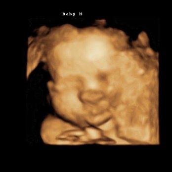 4D Miracles - Ultrasound Imaging Centers Near Me - Fremont, California 4D Miracles - Ultrasound Imaging Centers Near Me - Fremont, California