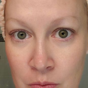 Dorner Plastic Surgery - Zero makeup. My skin last week. - Skin Care Near Me - Dublin, Ohio