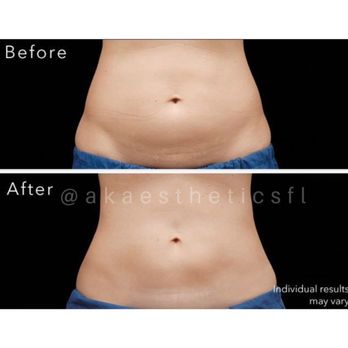 AK Aesthetics - Body Contouring - Laser Lipo - Skin Care Near Me AK Aesthetics - Body Contouring - Laser Lipo - Skin Care Near Me