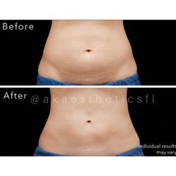 AK Aesthetics - Body Contouring - Laser Lipo