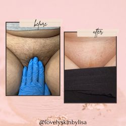 Lovely Skin By Lisa - Brazilian before & after