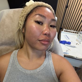 Sol And Skin - After microneedling a/ PRDN session - Medical Spas Near Me - San Diego, California Sol And Skin - After microneedling a/ PRDN session - Medical Spas Near Me - San Diego, California