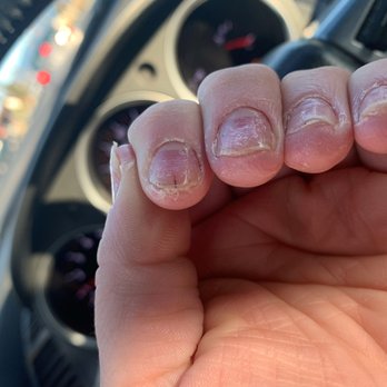 Super Nails - my hands after i took off my nails that i only had on for a week and a half - Nail Salons Near Me - Fontana, California Super Nails - my hands after i took off my nails that i only had on for a week and a half - Nail Salons Near Me - Fontana, California