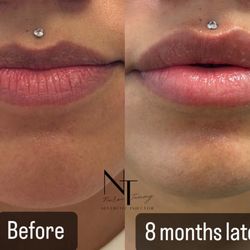 The Aesthetics Lab - Lip Filler