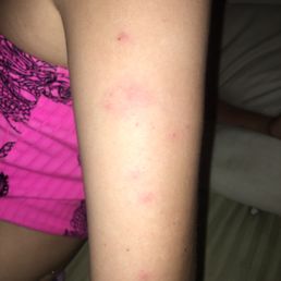 What I believe to be bed bug bites after being in a pedicure chair of theirs