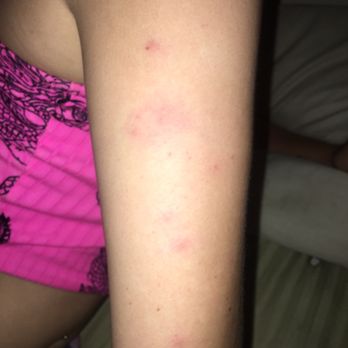 Pro Nails - What I believe to be bed bug bites after being in a pedicure chair of theirs - Nail Salons Near Me - Fairborn, Ohio