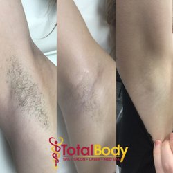 Total Body Laser & Med Spa Madison - Laser Hair Removal.