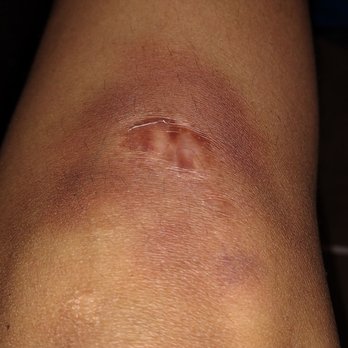 Escapade Games - Here you can see a large bruise I gained from one of my many falls to the floor. - Escape Games Near Me - Fullerton, California