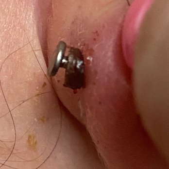 Piercing Vegas - That is a huge ring of crusted blood. 3rd hole on both sides looked this bad- the one Travis did. this was done in June- it's now December. - Piercing Near Me - Las Vegas, Nevada