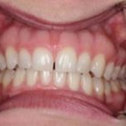 Studio City Dental Arts - Before: Veneers